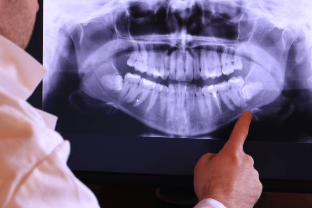 Best Emergency Tooth Extraction in Gig Harbor, WA